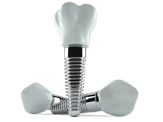 Full Service Dental Implants